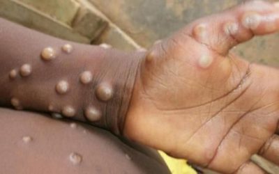 Variole du singe : ils sont capables de tout !